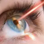 Tecnologia laser per la cura degli occhi: come funziona