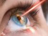 Tecnologia laser per la cura degli occhi: come funziona